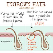 Prepping your skin before and after waxing is perhaps one of the most tips to prevent ingrown hairs. Ingrown Hair Ways To Prevent Ingrown Hairs After Shaving