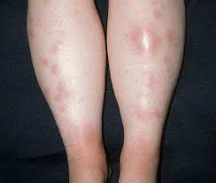 Image result for erythema nodosum