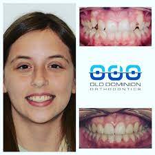 Having seen the downsides of large corporate offices, he created old dominion orthodontics to provide a more personal experience for his patients. Old Dominion Orthodontics Home Facebook