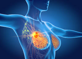 When the tumor is small in the early redness or pitting of the breast skin (like the skin of an orange). Novel Therapies For Metastatic Triple Negative Breast Cancer Spotlight On Immunotherapy And Antibody Drug Conjugates