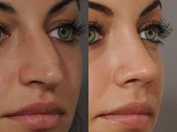 Wie Viel Kostet Eine Nasenkorrektur Kosten Deutsch Style Rhinoplasty Cost Nose Surgery Nose Job