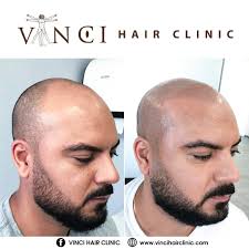 Islamic dream interpretation dream meanings and dream dictionary. While Many Balding Men Only Dream Vinci Hair Clinic Facebook