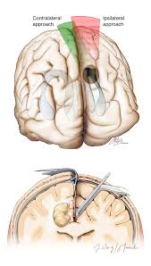 Contralateral Interhemispheric Transfalcine Transprecuneus Approach The Neurosurgical Atlas
