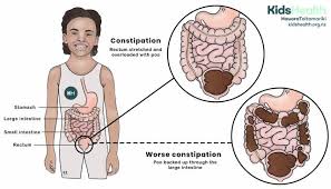 Image result for Pediatric Constipation