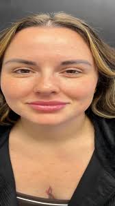 ✨From subtle to stunning! ✨, Swipe to see this gorgeous lip filler refresh  — adding volume, definition, and hydration while keeping it natural and YOU  💋, Ready to enhance your pout with confidence? ...