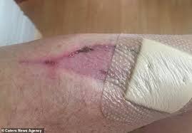 Blood poisoning (also referred to as sepsis or septicemia) is a severe infection that is spread through the body via the blood stream. Dog Lover Lucky To Be Alive After Scratch From Pet Turns Into Sepsis Hot Lifestyle News