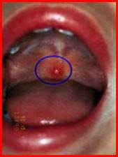 ملف كامل بل صور عن الجديري المائي العنقز chickenpox varicella