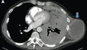 The ct differentiation of benign and malignant pleural disease is. Heritable Mutations May Indicate Responsiveness To Platinum Chemotherapy In Malignant Mesothelioma Center For Cancer Research