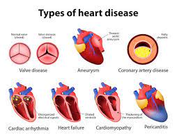 Heart disease Causes, Symptoms & Treatment -Clicks Health Hub