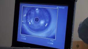 Laser Eye Surgery Stock Video Footage By C Prostock 60640669