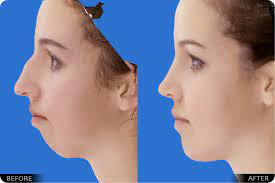 Jaw Surgery Orthognathic Surgery Facial Surgery