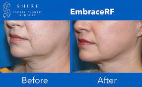 Check spelling or type a new query. Embracerf Before After Shire Facial Plastic Surgery