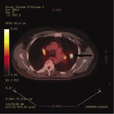 Sarcoidosis results from small areas of inflamed cells that cause lost lung capacity, reducing the amount of air the lungs can hold. View Of Coal Worker S Pneumoconiosis And Sarcoid Like Reaction Mimicking Lymph Node Metastases In A Patient With Lung Cancer A Case Report The Southwest Respiratory And Critical Care Chronicles