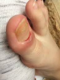 Image result for Akutní zánět nehtového lůžka