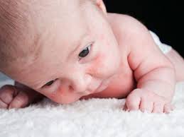 Der milchschorf ist für euer baby nicht weiter schlimm und vergeht auch wieder. Milchschorf Entfernen Vorbeugen Unterscheidung Zum Kopfgneis 9monate De