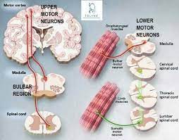 Upper Motor Vs Lower Motor Neuron Disease How To Relief Motor Neuron Neurons Motor Neuron Disease Treatment