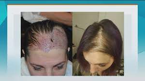 Instead, the hair shedding usually becomes noticeable one or two months after the shock. Operation Restore Helps Patients Suffering From Trauma And Disease Fight Hair Loss New Day Northwest King5 Com