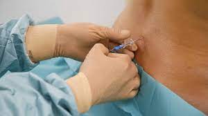 Epidural For Labor Epidural Injection Side Effects Risks And More