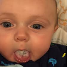 Let's discuss the types of black spots on the tongue people have. Baby Has Black In His Tongue August 2015 Babies Forums What To Expect