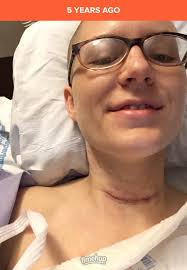 Follow up after total laryngectomy surgery