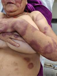 Image result for Leprosy
