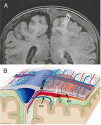 Challenging The Pathophysiologic Connection Between Subdural Hematoma Retinal Hemorrhage And Shaken Baby Syndrome The Western Journal Of Emergency Medicine