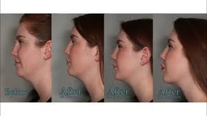 It took me about three weeks to get back to baseline. Kendall S Amazing Kybella Results