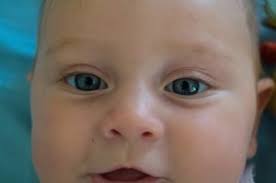 Ist das normal, dass er jetzt noch schielt und wenn ja, ab wann dürfte er nicht mehr schielen? Das Baby Schielt Ursachen Und Behandlungsmoglichkeiten Im Uberblick