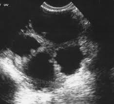 However, if the ultrasound reveals a complex cyst or solid. Diagnostic Ultrasound In The Assessment Of The Adnexal Mass Glowm