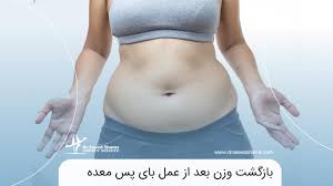 بعد از عمل اسلیو چقدر باید راه رفت+بوتاکس معده چگونه است+بوتاکس معده برای چه وزنی مناسب است+کدام عمل لاغری بدون بازگشت است