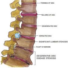 Fusion Surgery For Lumbar Spinal Stenosis Wfns Spine Committee Recommendations Sciencedirect