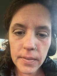 Could anyone help me with a regimen to deal with the inflammation. I have  severe inflammation everywhere including my lungs. I can no longer drink  coffee or alcohol which ignites the inflammation