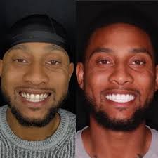 SUSAN FREDERICKS, DDS MPH