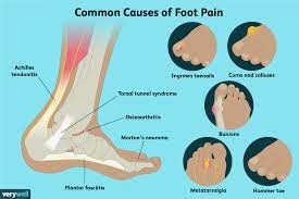 Anatomical diagram of the foot and ankle highlighting effects of posterior tibial tendon insufficiency. Foot Anatomy Physiology And Common Conditions