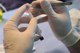 Con la sessione di trapianto di capelli con il metodo fue senza tagliare dei capelli il/la interessato /a ha la possibilità di ripristinare . Trapianto Di Capelli Senza Rasatura Estecapelli