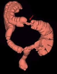 Pappou, a colorectal surgeon at memorial sloan kettering cancer center in new york. Apple Core Sign In Colorectal Cancer Springerlink
