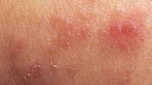 How To Get Rid Of An Armpit Rash Armpit Rash Armpits Smell Underarm Rash