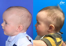 Sagittal craniosynostosis هل يمكن الوقاية من تعظّم الدروز الباكر؟