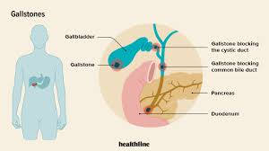 Gallstones: Symptoms, Causes, Treatment, and More