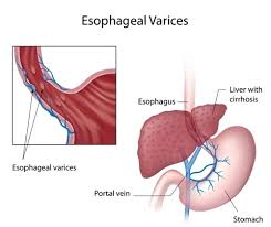 The vessels make up two closed systems of tubes that the other system, the systemic vessels, carries blood from the left ventricle to the tissues in all parts of the body and then returns the blood to the. Esophageal Varices