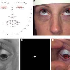 PDF) Kinematics of the Upper Eyelid and the Globe During Downward Excursion  With Comparative Analysis in Patients With Thyroid Eye Disease