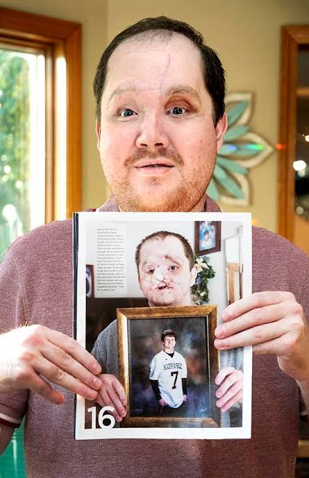 Family sees God's hand in son's survival after suicide attempt, successful  face transplant - Catholic Review