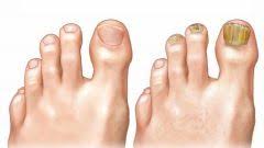 Dogal Camasir Suyu Nasil Yapilir Kadin Halleri Laser Eye Surgery Cost Nail Fungus Toenail Fungus Remedies