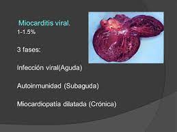 La miocarditis viral es una afección patológica de génesis viral con daño miocárdico (músculo la miocarditis viral no requiere tratamiento específico, ya que puede curarse sola, sin embargo, los. Miocarditis Ppt Descargar