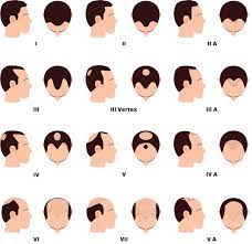 In the united states, 50 million men experience hair loss from androgenetic alopecia, or male pattern baldness. Male Pattern Baldness International Hair Studio