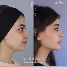 فيلر تعبئة الخفسات و رفع المؤخرة و زيادة الحجم بشكل جميل و طبيعي اذا كنتو  تعانون من الخفسات فيلر الجسم حل امن و يعطيكم شكل انثوي جميل و كونتور جذاب  الجسم بدون