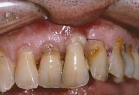 Image result for Periodontitis