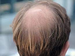 Malte villnow unters messer gelegt hat. Beispiel Jurgen Klopp So Funktioniert Eine Haartransplantation Kolner Stadt Anzeiger