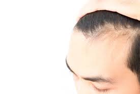 How to prevent hair loss? Five Ways To Help Prevent Hair Loss In Men Lifestyle The Jakarta Post