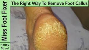 Foot polish, callus remover, dead skin remover, foot exfoliator, foot scrub, foot care, foot polish (japanese peppermint). Satisfying Callus Heel Foot Scraping Cracked Heels Fissures Foot Fixer Marion Yau Youtube